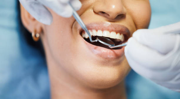 Best Knocked-Out Tooth (Avulsed Tooth) Treatment in Pelzer, SC